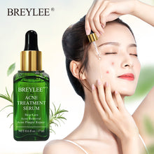 將圖片載入圖庫檢視器 Treatment Face Serum Mask Anti Acne Pimple Scar Remover Moisturizing